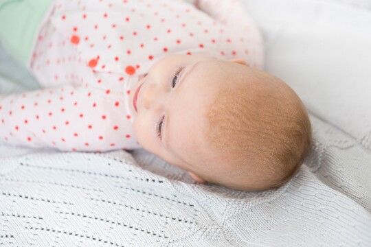 Baby mit Kopfgneis Baby mit Kopfgneis